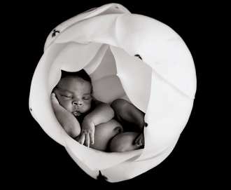 新生儿上睑下垂需手术治疗